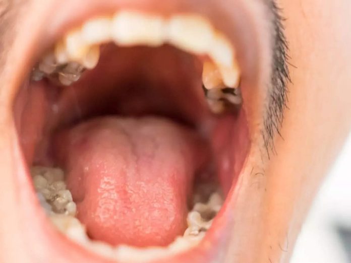 oral cancer