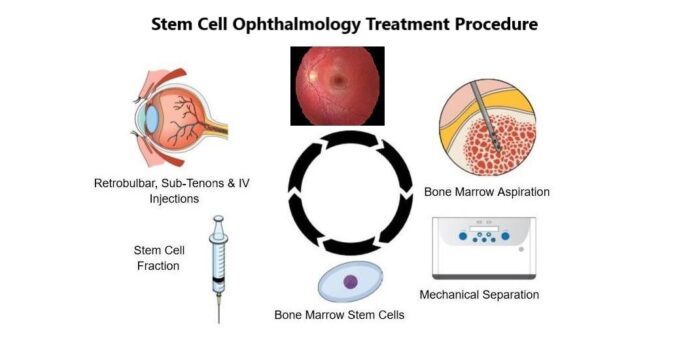 Age Related Macular Degeneration (AMD) Vision Improves with MD Stem Cells Treatment