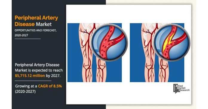Peripheral Artery Disease Market Trends, Business Strategies and Opportunities With Key Players Analysis 2027