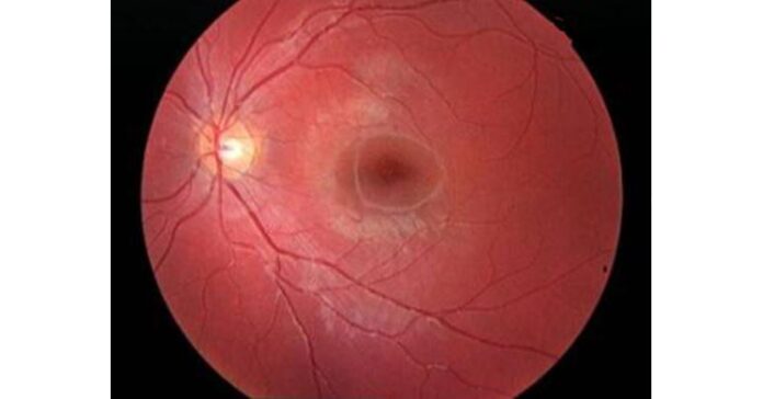 Stargardt Disease Treatment Significantly Improves Vision