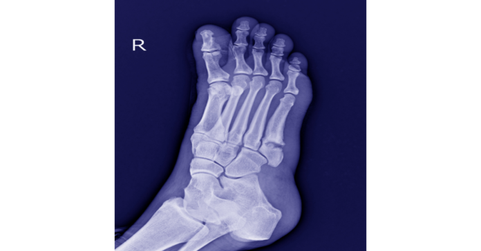 Stryker Dominates Global Small Bone and Joint Market, with DePuy Synthes and Zimmer Biomet in Close Pursuit