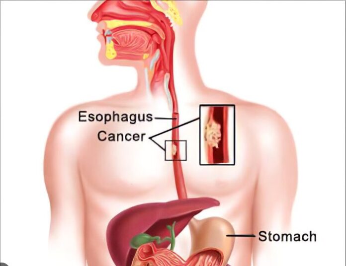 Food Pipe Cancer