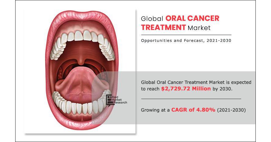 Oral Cancer Treatment Market Expected to Reach $2.7 Billion by Oral Cancer Treatment Market Expected to Reach $2.7 Billion by 2030