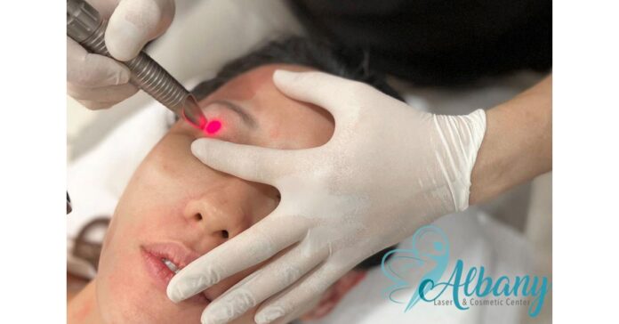 Albany Cosmetic and Laser Centre Introduces Innovative Vectorlift Treatment with Fotona