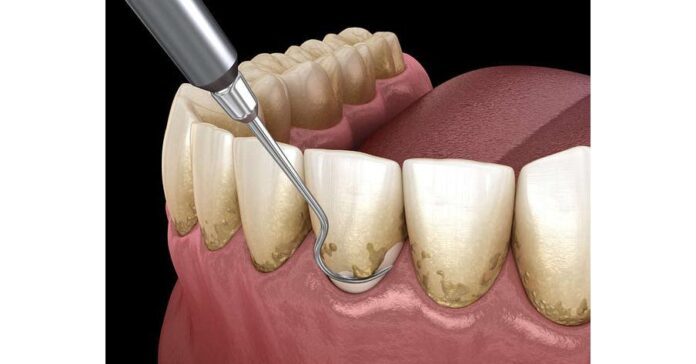Discover Effective Methods and Tips for a Dazzling Smile