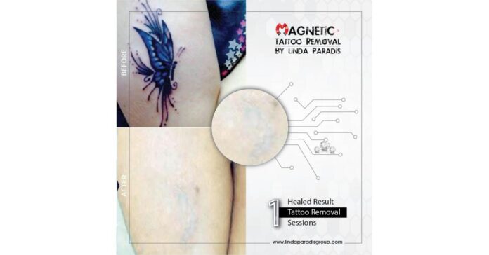 Magnetic Tattoo Removal vs Saline Tattoo Removal