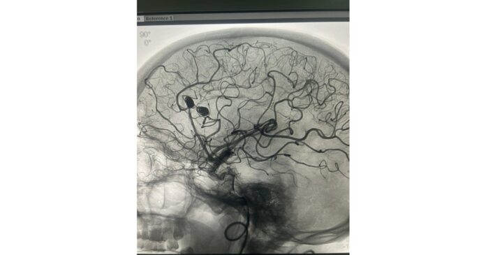Jaipurs Eternal Hospital Achieves Remarkable Milestone in Neurointerventional Surgery Treating Multiple Ruptured Distal ACA Aneurysms Through Endovascular Coiling in the Cathlab