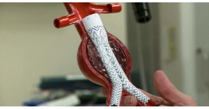 Abdominal Aortic Aneurysm (AAA) Repair Devices Market: Advancements in Aortic Health