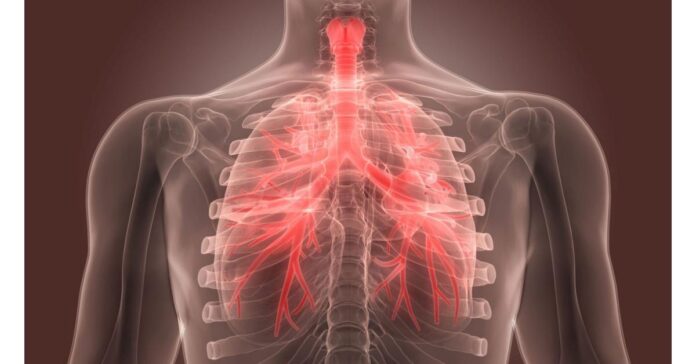Bronchitis Market Report 2023-2033 | Industry Size, Growth and Latest Insights