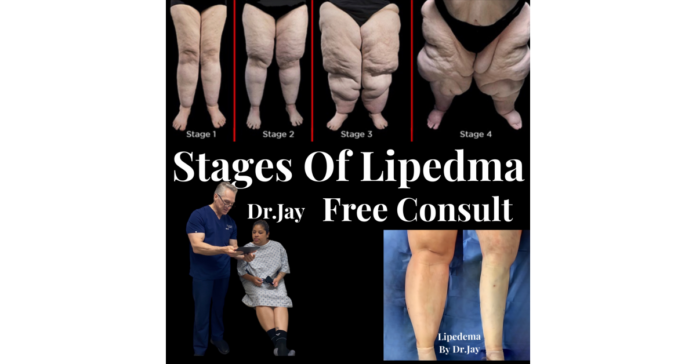 Pacific Rejuvenation Medical Is Getting Popular For Offering Reliable Relief From Lipedema