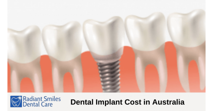 Radiant Smiles Dental Care Shares Guide on Implant Costs in Australia