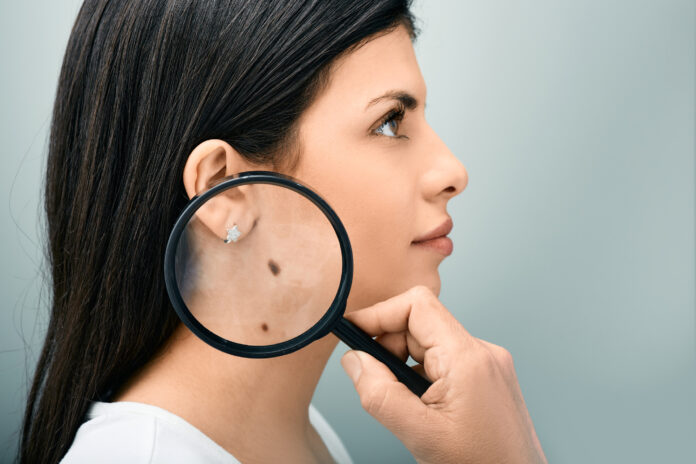 skin cancer screening