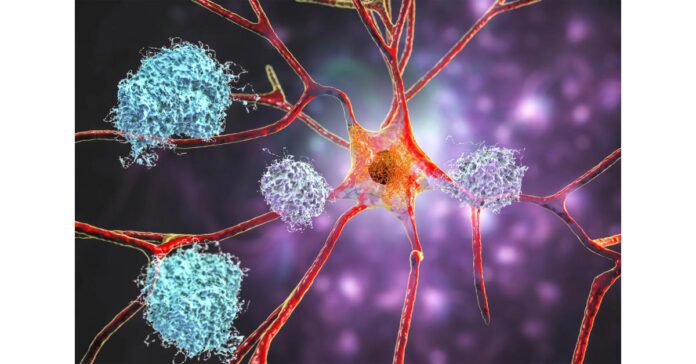 alzheimer-s-drug-market.jpeg Alzheimer’s Drug Market to Witness Stunning Growth with CAGR of 20.1%