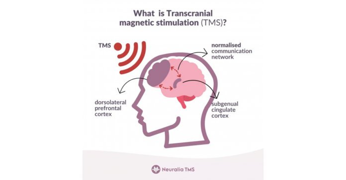 Pioneering Transcranial Magnetic Stimulation Therapy for Mental Health and Chronic Pain in Perth