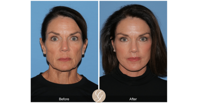 Preservation Facelift the Next Generation of Deep Plane Facelift Technique