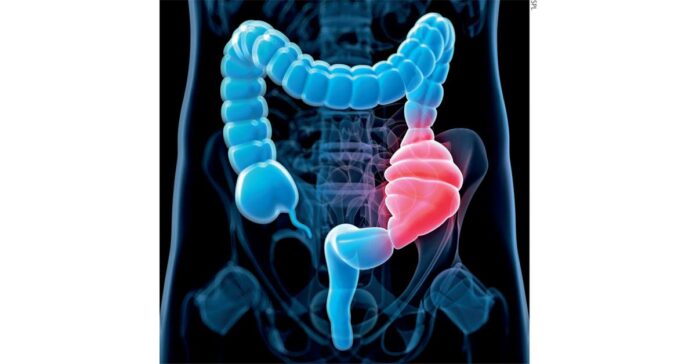 Chronic Idiopathic Constipation Market Size, Trends, Industry Statistics and Latest Chronic Idiopathic Constipation Market Size, Trends, Industry Statistics and Latest Insights Till 2033