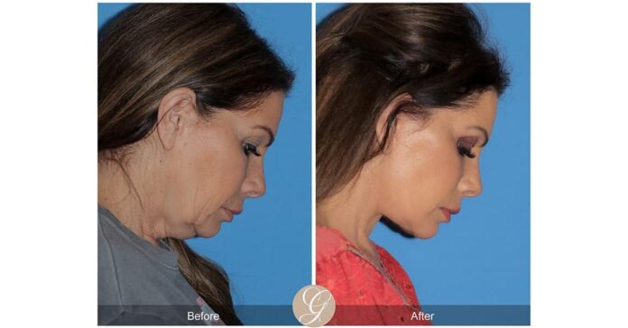 The Superiority of Deep Plane Facelift vs. Traditional Facelift Explained